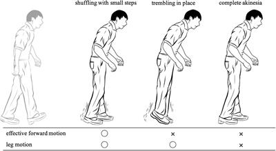 Measurement Accuracy of Freezing of Gait Scoring Based on Videos